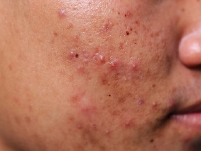 ace Se Pimple Kaise Hataye