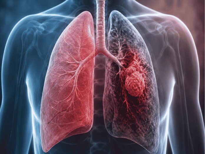 Lung Cancer Symptoms