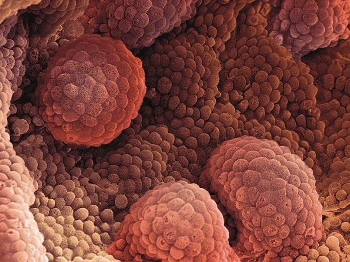 Prostate Cancer